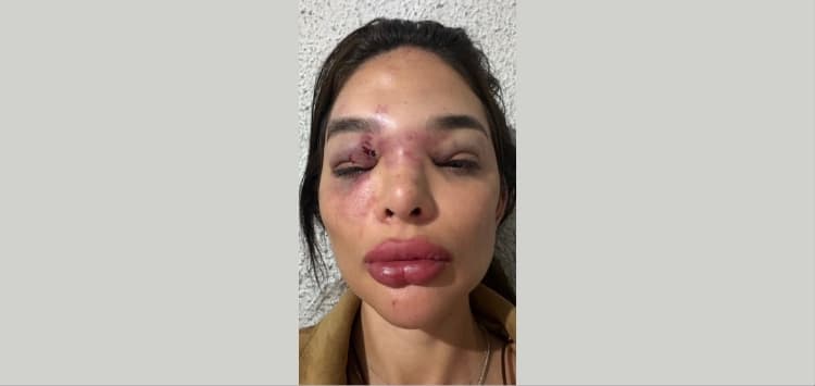 (Vídeo)Mulher denuncia agressões com taco de beisebol e empresário da Faria Lima é preso em SP